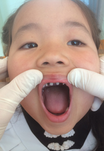mongolian childs teeth in Mongolia with Pediatric Dentist from Fort Lee and Westwood, NJ